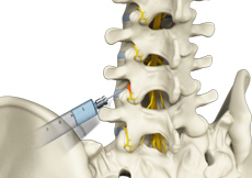 Lumbar Spinal Injections
